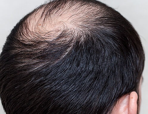 alopecia androgenetica que es