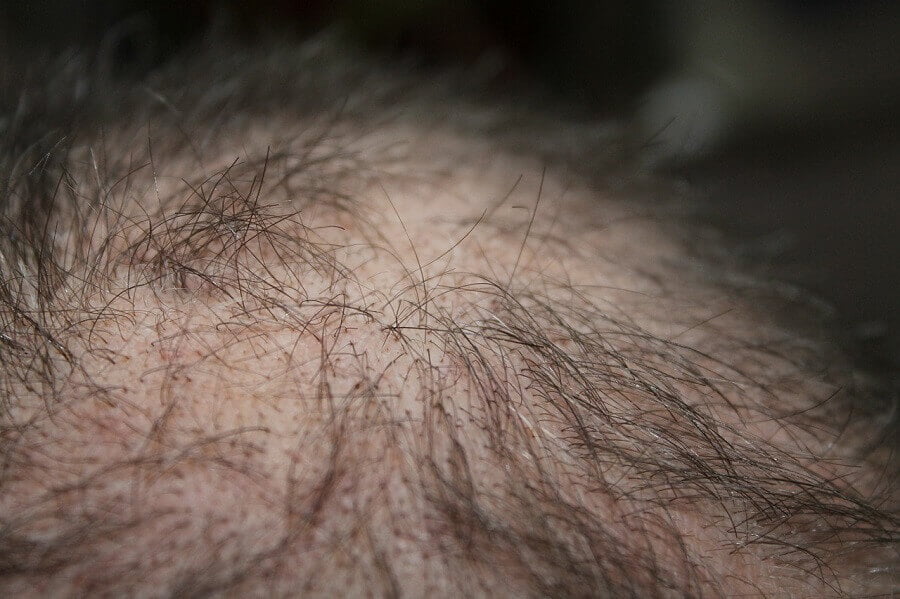 Trasplante de cabello en Barcelona