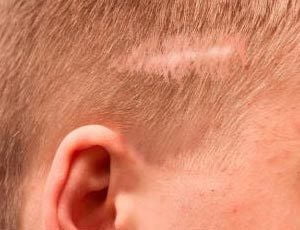 no crecimiento del pelo por cicatriz