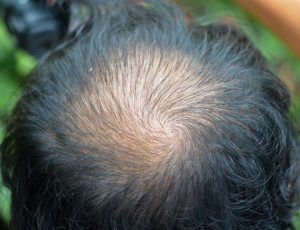Alopecia difusa en hombres