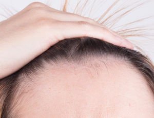 que es la alopecia fibrosante imagen