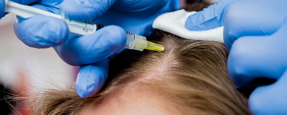 mesoterapia Mesoterapia capilar en Barcelona