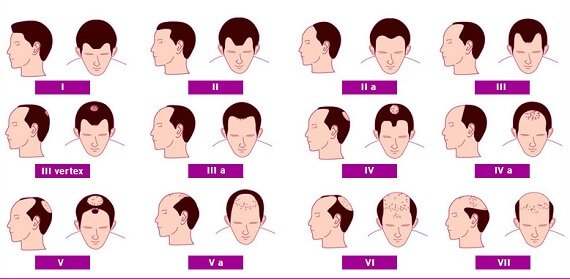 La escala de Hamilton Norwood
