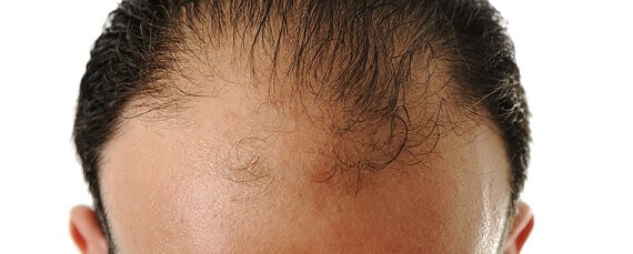 calvicie tratamiento