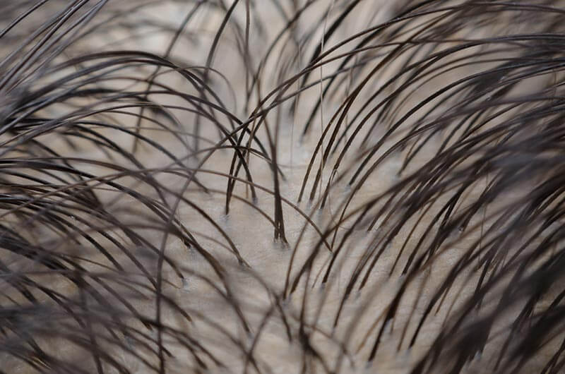 Los tipos de alopecia