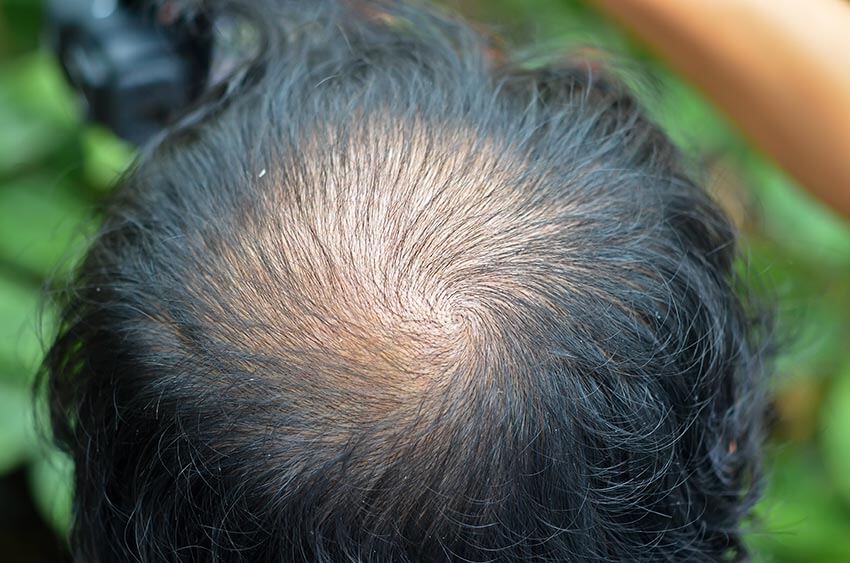 soluciones a la alopecia masculina
