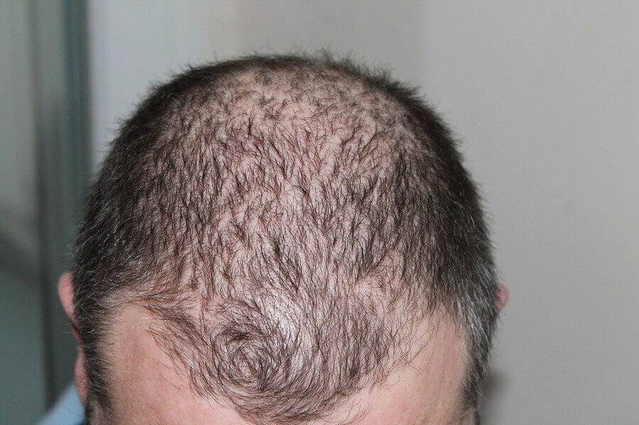 Mitos sobre la pérdida de cabello