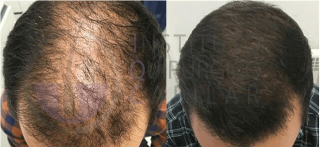 Trasplante capilar: antes y después del tratamiento en el Instituto Quirúrgico Capilar