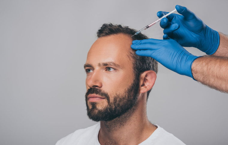 Injerto capilar en las entradas