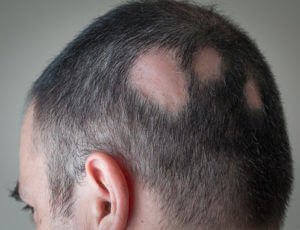 tratamiento alopecia areata IQC