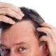 1. Caída del cabello posterior al procedimiento