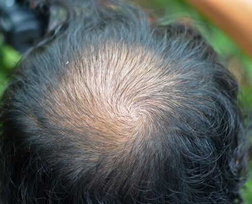 soluciones a la alopecia masculina