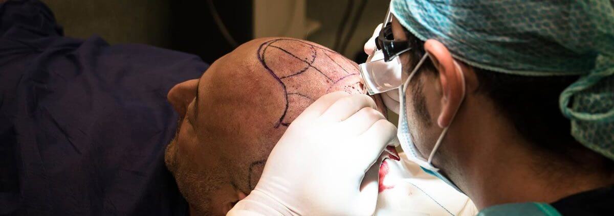 durante_la_operacion Qué técnica de trasplante capilar es la más adecuada para ti
