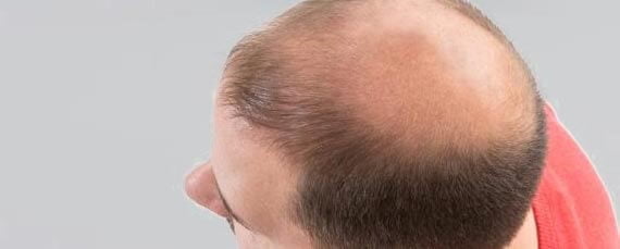 alopecia hombre