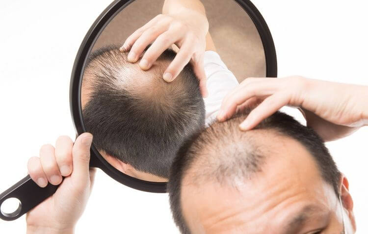 Implante capilar para recuperar el pelo de la coronilla