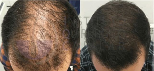 Trasplante capilar: antes y después del tratamiento en el Instituto Quirúrgico Capilar