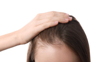 La alopecia femenina