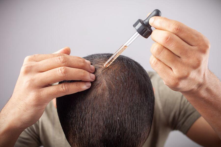 Minoxidil ¿Hay que lavarse el pelo después de usar minoxidil?